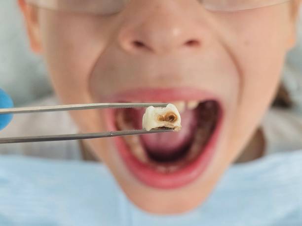 Best Emergency Treatment for Dental Infections or Abscesses in Stillwater, OK